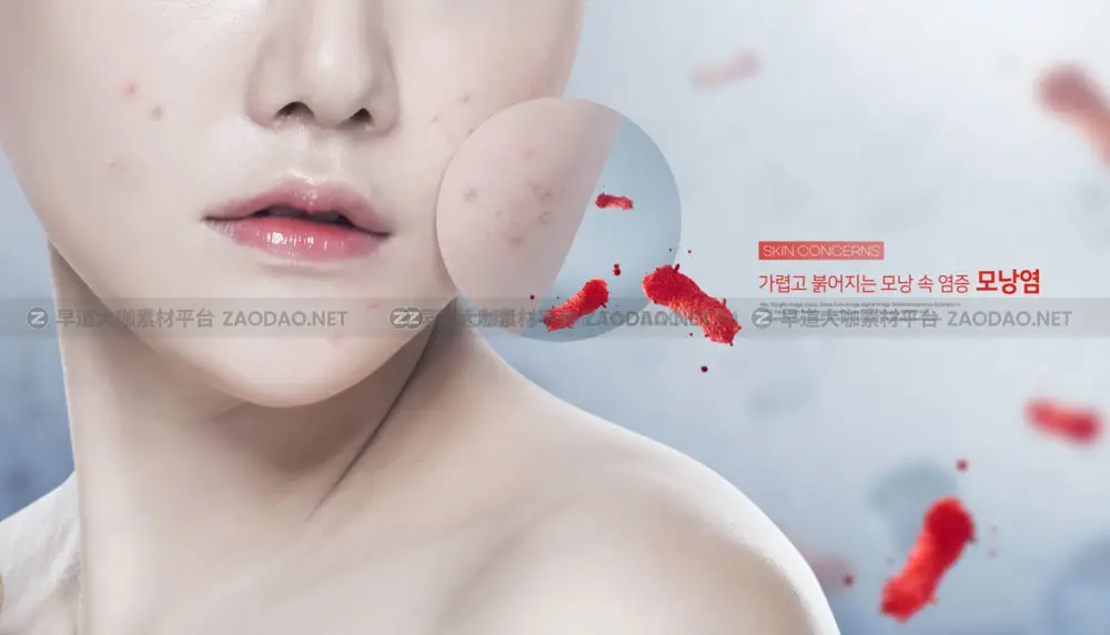 13款皮肤护理保养美容祛痘海报设计PSD模板源文件 Beauty Acne Poster PSD Template插图7